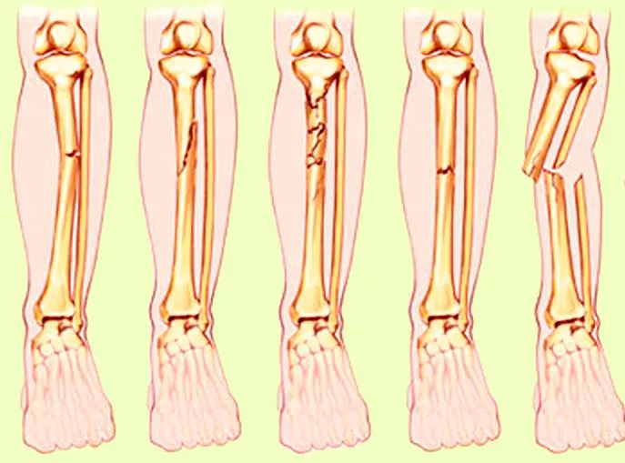 Complex Fracture Treatment