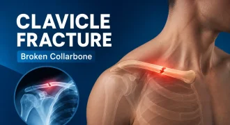 Clavicle Fracture (Broken Collarbone): Causes, Symptoms, Treatment & Full Recovery Guide